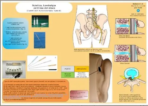 Il trattamento della sciatica con l'Auricoloterapia.