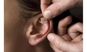 Auricoloterapia con semi di Vaccaria. Auricoloterapia con semi di Vaccaria. Dott. P. Ventura.